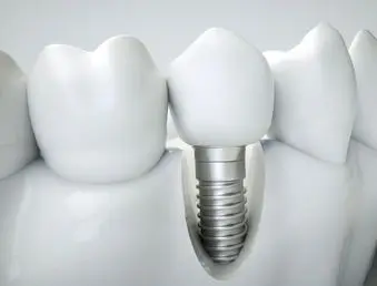Dinti ficsi – DentFamily