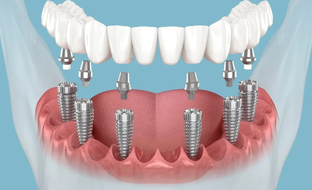 Dinti ficsi pe 4-6 implanturi dentare